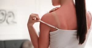 Kulit Sunburn